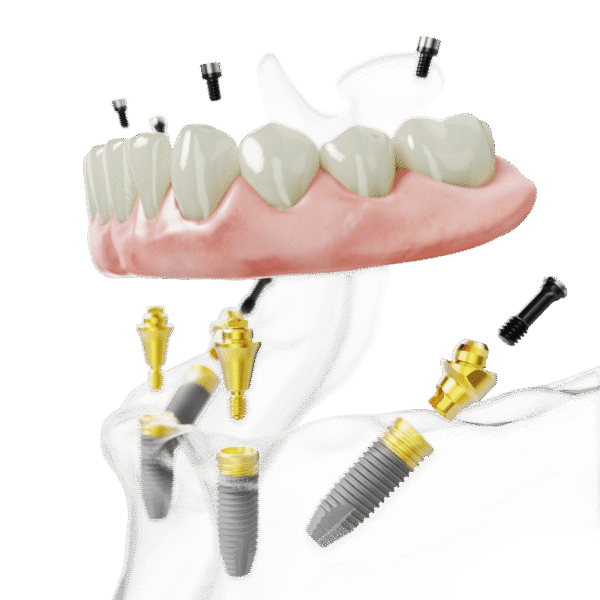 All-on-4 TiUltra_hero 1_lower jaw NobelParallel (1)