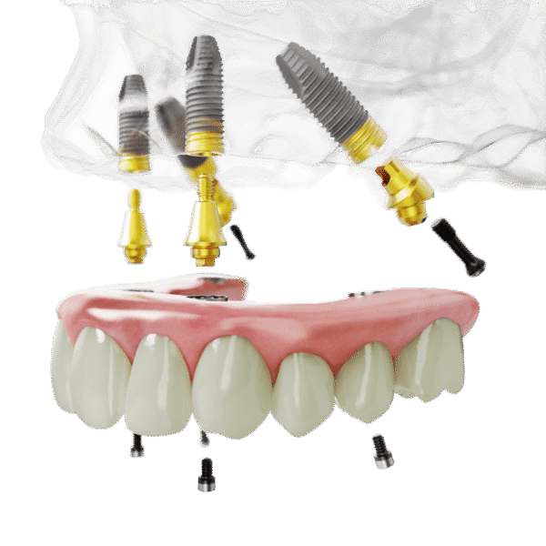 All-on-4 TiUltra_upper jaw NobelParallel